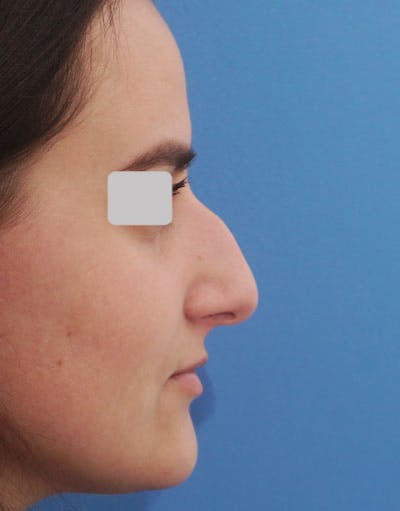 Rhinoplasty Before & After Gallery - Patient 288207 - Image 1