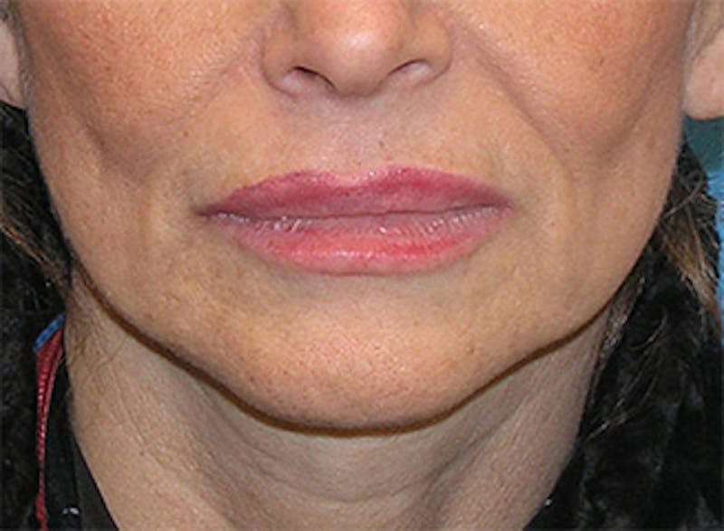 Facelift Before & After Gallery - Patient 192314 - Image 7