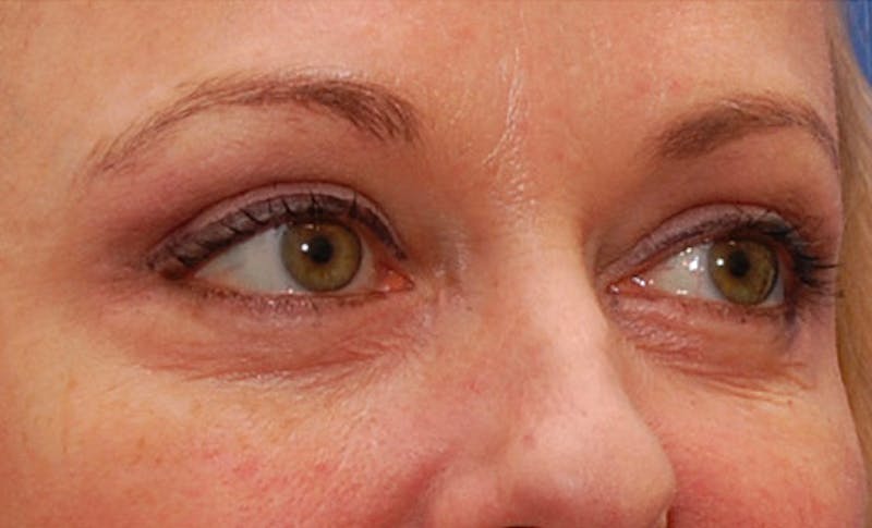Fillers Before & After Gallery - Patient 201225 - Image 3