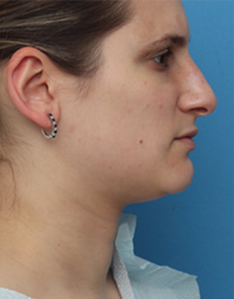 Jawline Contouring Before & After Gallery - Patient 197923 - Image 2