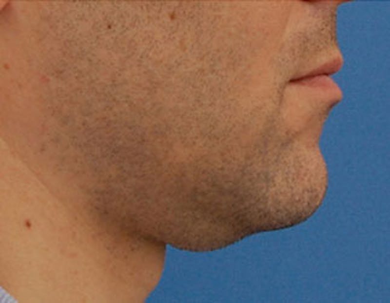 Kybella Before & After Gallery - Patient 144039 - Image 5