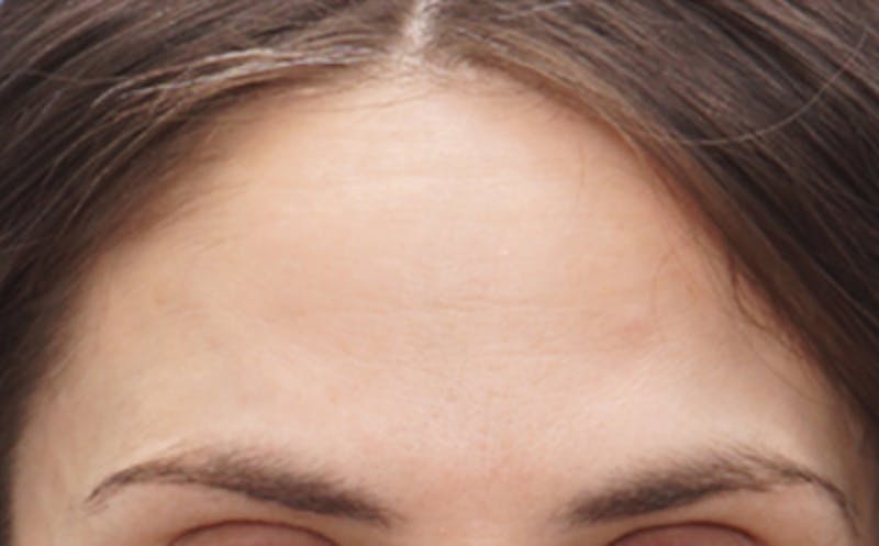 BOTOX Before & After Gallery - Patient 382021 - Image 4
