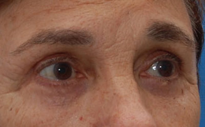 Eyelid Surgery Before & After Gallery - Patient 133362 - Image 4