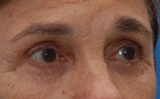 Eyelid Surgery Before & After Gallery - Patient 133362 - Image 4