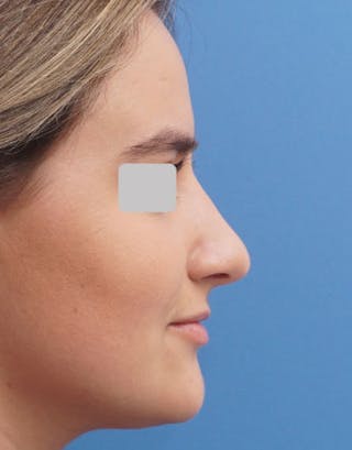 Rhinoplasty Before & After Gallery - Patient 288207 - Image 2
