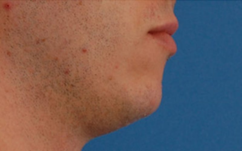 Chin Surgery Before & After Gallery - Patient 259350 - Image 2