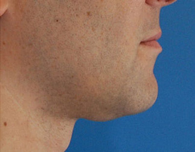 Kybella Before & After Gallery - Patient 144039 - Image 6