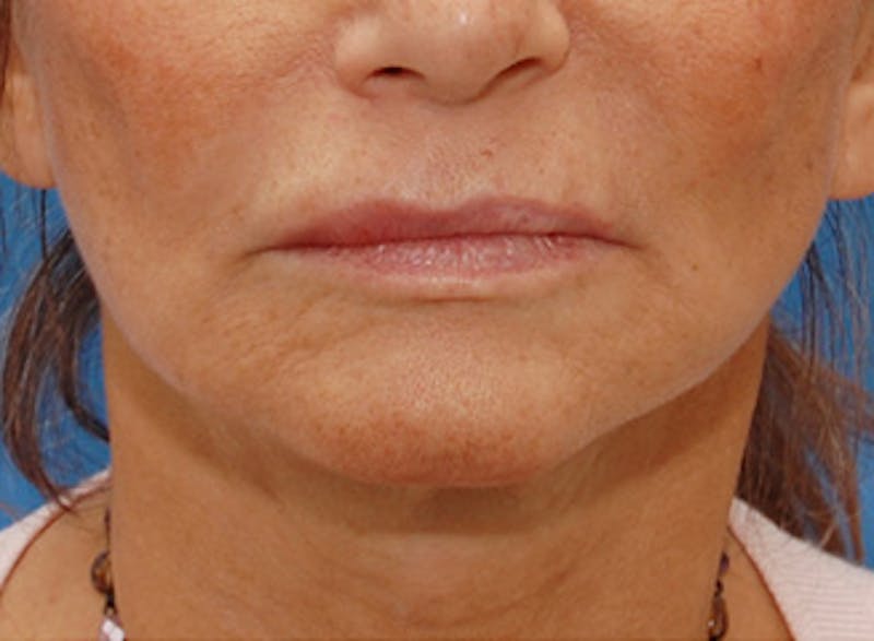 Facelift Before & After Gallery - Patient 192314 - Image 8
