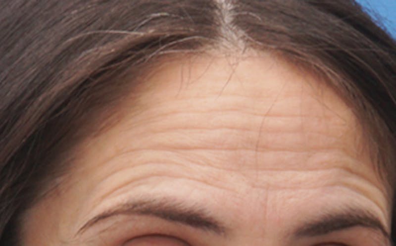 BOTOX Before & After Gallery - Patient 382021 - Image 5