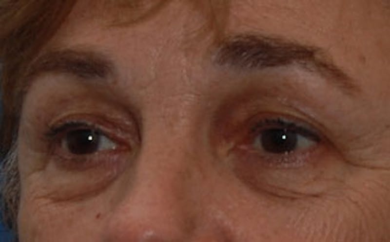 Eyelid Surgery Before & After Gallery - Patient 133362 - Image 5