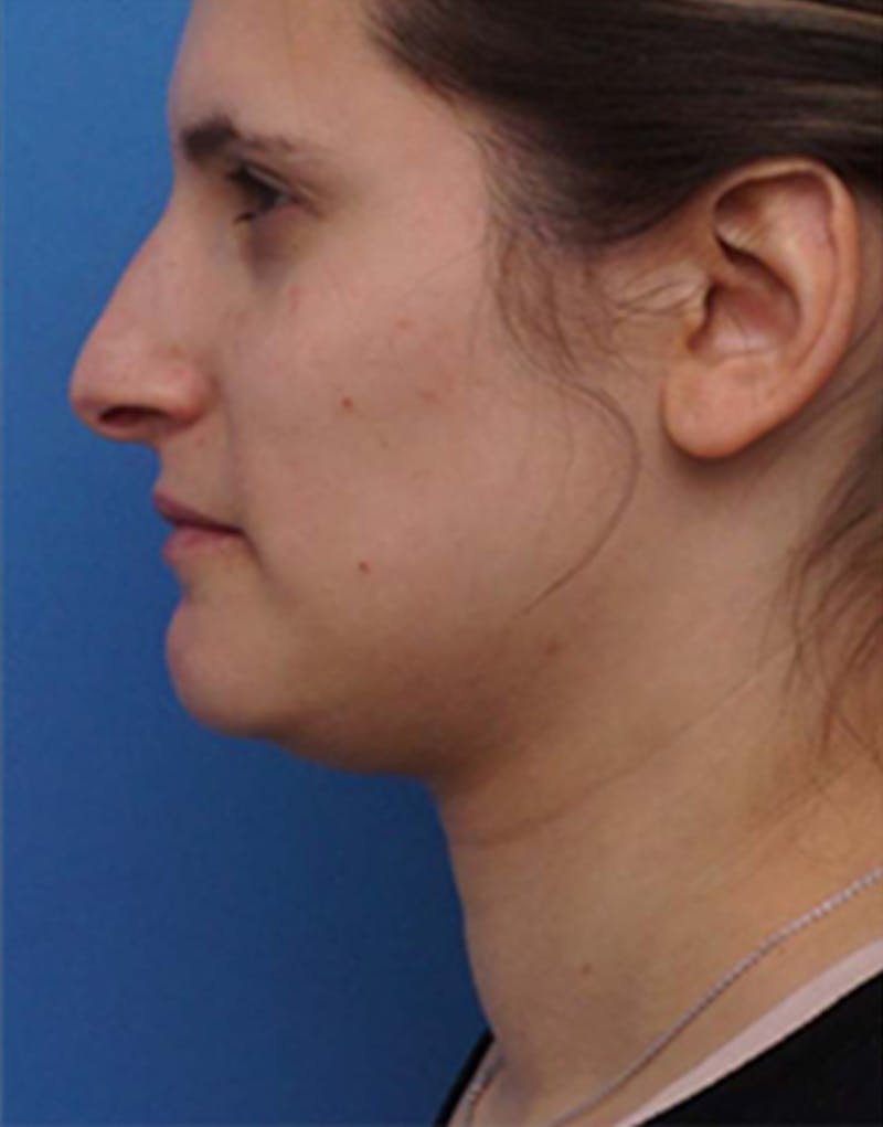 Jawline Contouring Before & After Gallery - Patient 197923 - Image 3