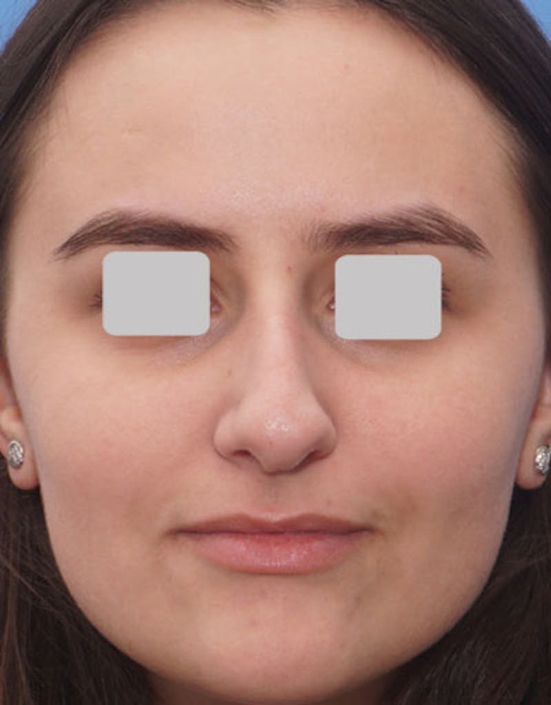 Rhinoplasty  Before & After Gallery - Patient 288207 - Image 3