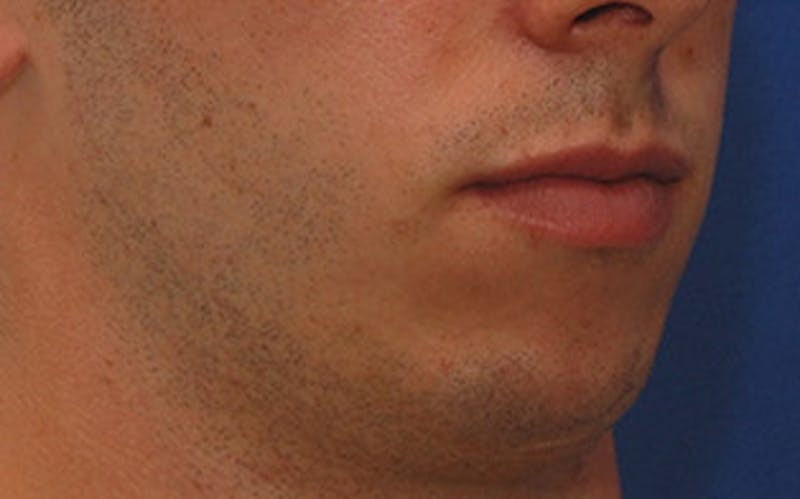Chin Surgery Before & After Gallery - Patient 259350 - Image 3