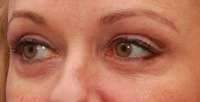 Fillers Before & After Gallery - Patient 201225 - Image 5