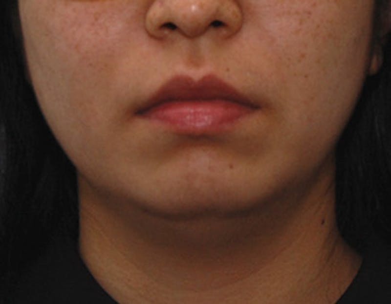 Kybella Before & After Gallery - Patient 379605 - Image 1