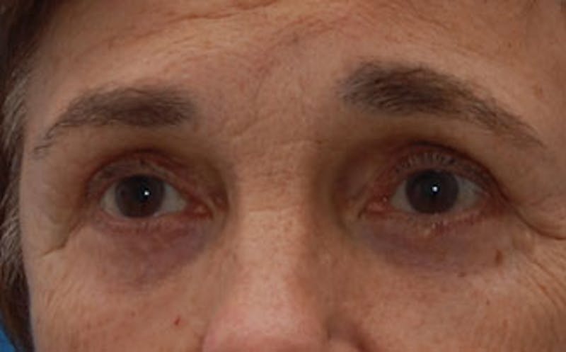 Eyelid Surgery Before & After Gallery - Patient 133362 - Image 6