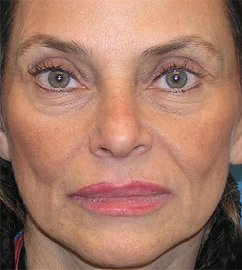 Facelift Before & After Gallery - Patient 295138 - Image 3