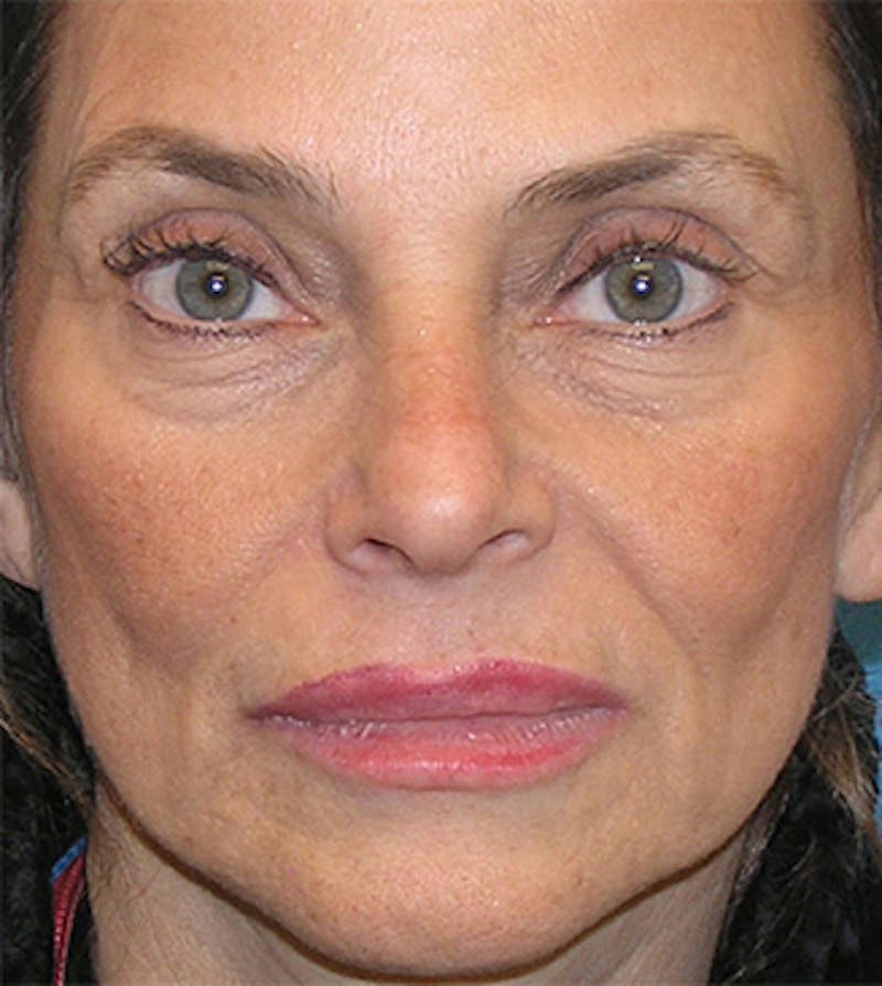 Patient UaTdmJKwRcu5ny_30tCKwg - Facelift Before & After Photos