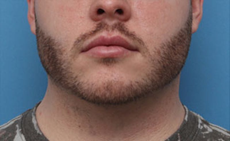 FaceTite Before & After Gallery - Patient 771200 - Image 3