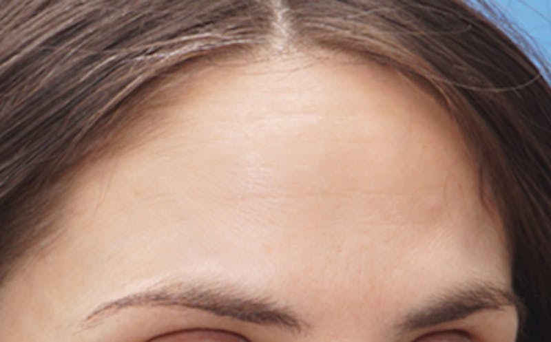 BOTOX Before & After Gallery - Patient 382021 - Image 6