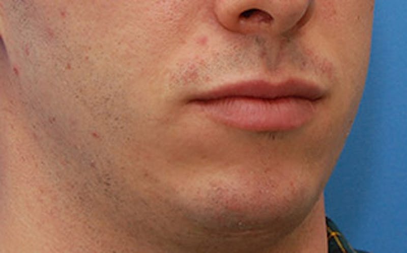 Chin Surgery Before & After Gallery - Patient 259350 - Image 4