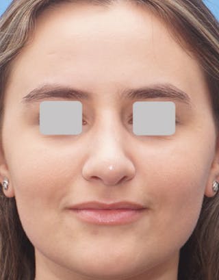 Rhinoplasty Before & After Gallery - Patient 288207 - Image 4