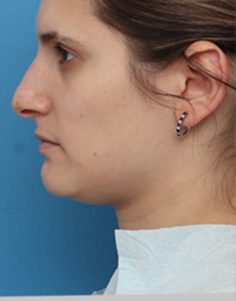 Jawline Contouring Before & After Gallery - Patient 197923 - Image 4