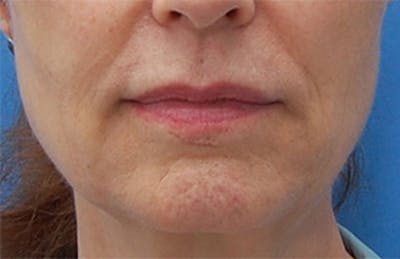 Fractora / Morpheus Before & After Gallery - Patient 269993 - Image 1