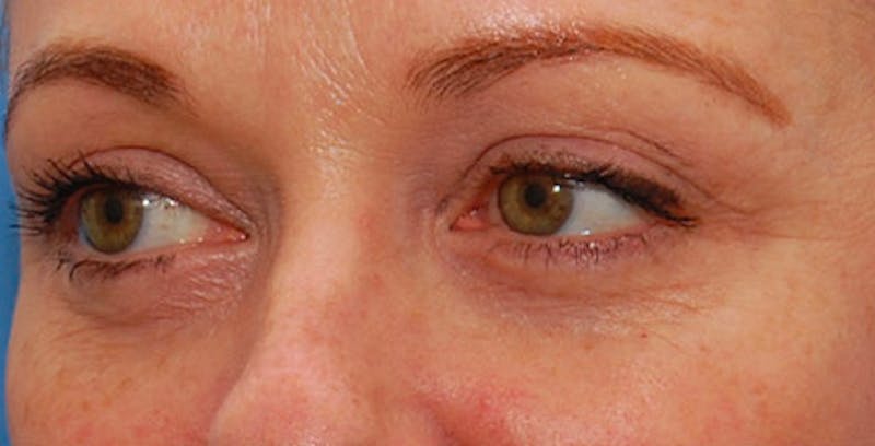Fillers Before & After Gallery - Patient 201225 - Image 6