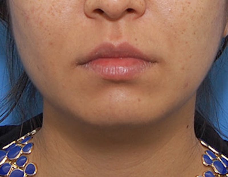 Kybella Before & After Gallery - Patient 379605 - Image 2