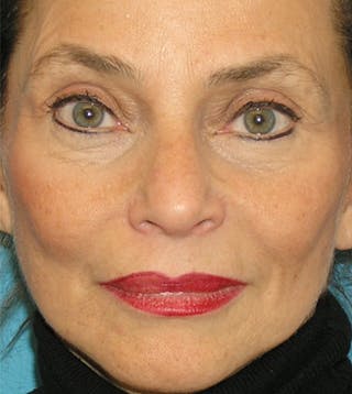 Facelift Before & After Gallery - Patient 295138 - Image 4