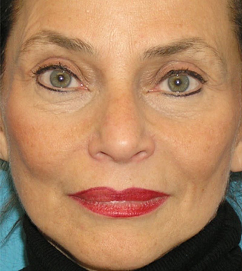 Facelift Before & After Gallery - Patient 295138 - Image 2