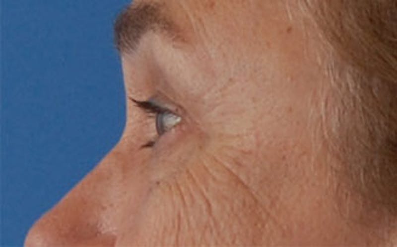 Eyelid Surgery Before & After Gallery - Patient 133362 - Image 7