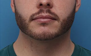 FaceTite Before & After Gallery - Patient 771200 - Image 4