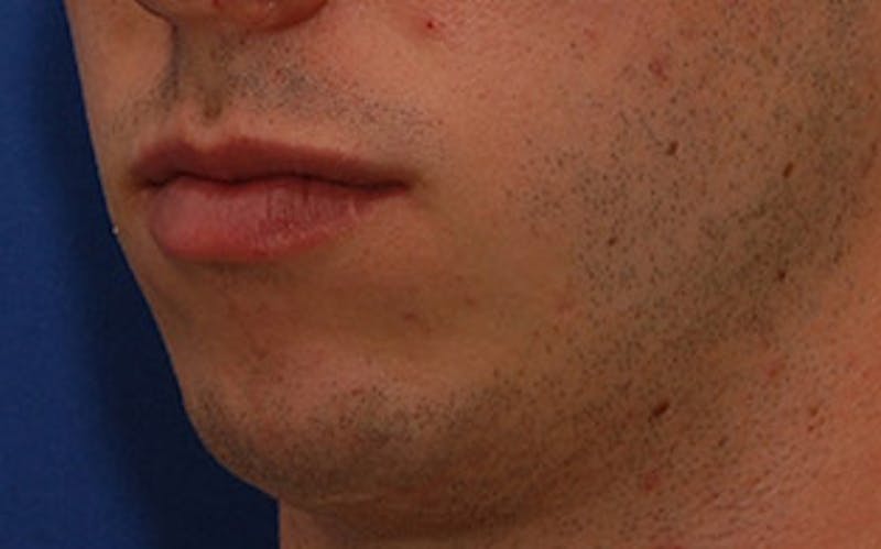 Chin Surgery Before & After Gallery - Patient 259350 - Image 5