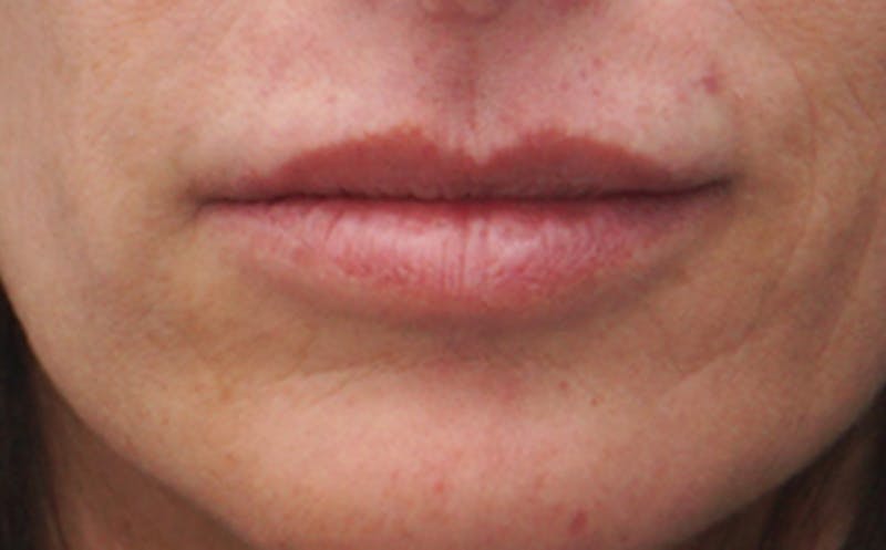 BOTOX Before & After Gallery - Patient 382021 - Image 7