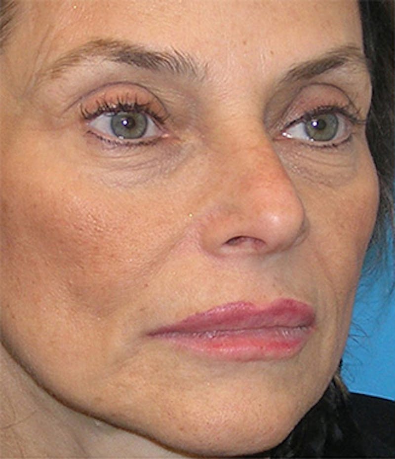 Facelift Before & After Gallery - Patient 295138 - Image 5