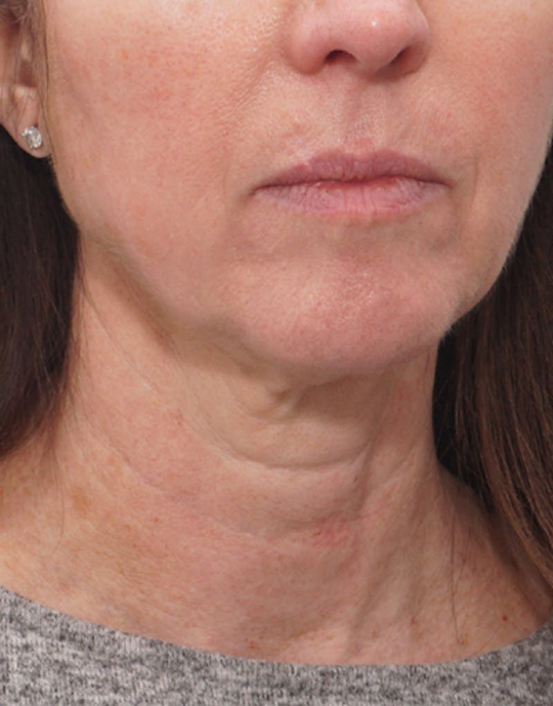 Patient UlE9AQCnSECFYGxLyI-qMw - Jawline Contouring Before & After Photos