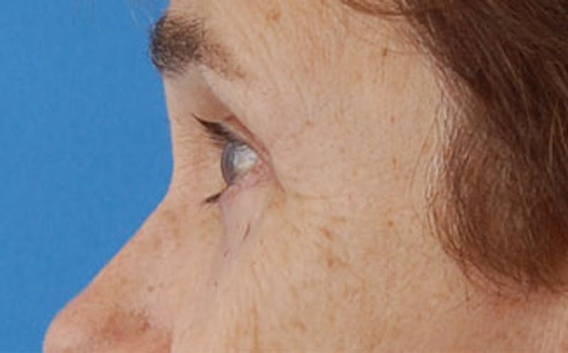 Eyelid Surgery Before & After Gallery - Patient 133362 - Image 8