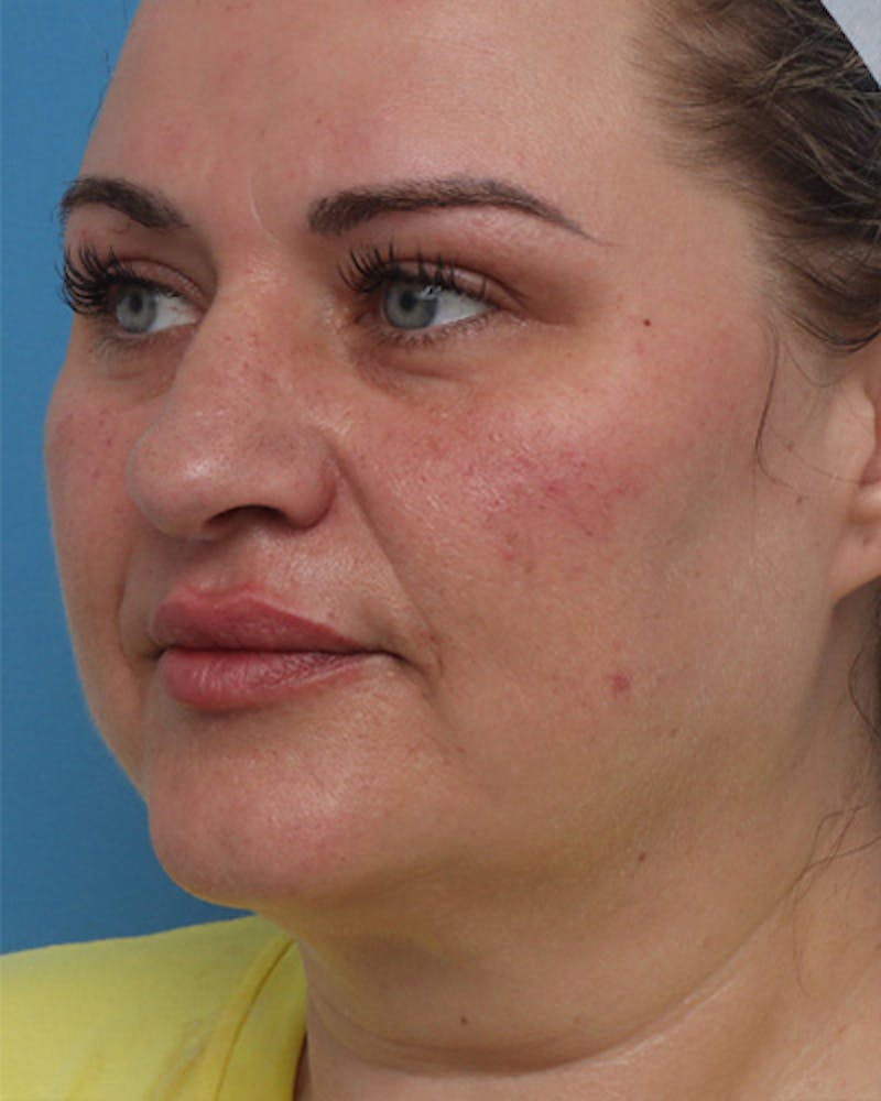 Lip Fillers Before & After Gallery - Patient 928618 - Image 4