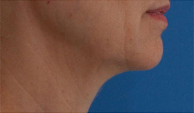 Fractora / Morpheus Before & After Gallery - Patient 269993 - Image 3