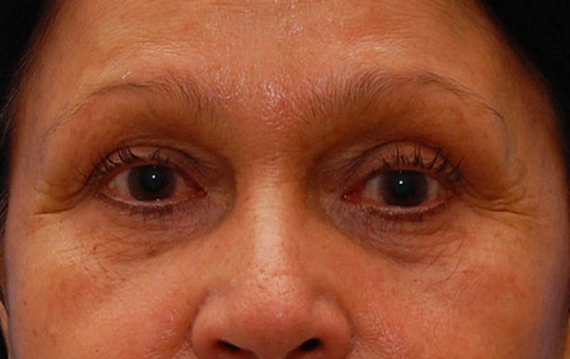 Fillers Before & After Gallery - Patient 416688 - Image 1