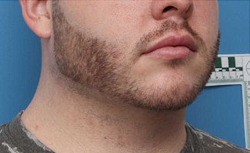 FaceTite Before & After Gallery - Patient 771200 - Image 5