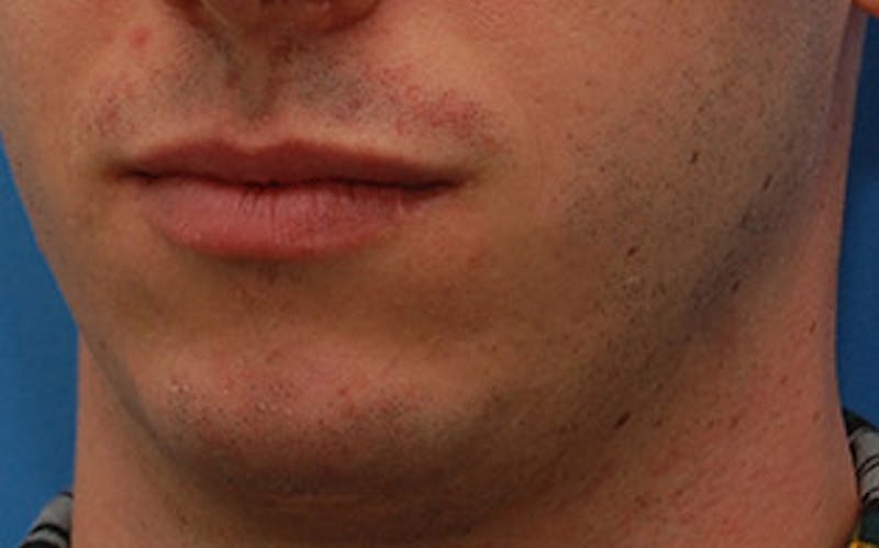 Chin Surgery Before & After Gallery - Patient 259350 - Image 6