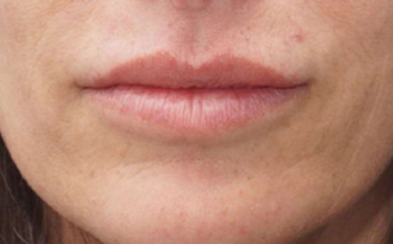 BOTOX Before & After Gallery - Patient 382021 - Image 8