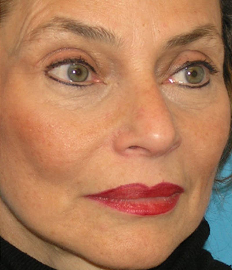 Facelift Before & After Gallery - Patient 295138 - Image 4