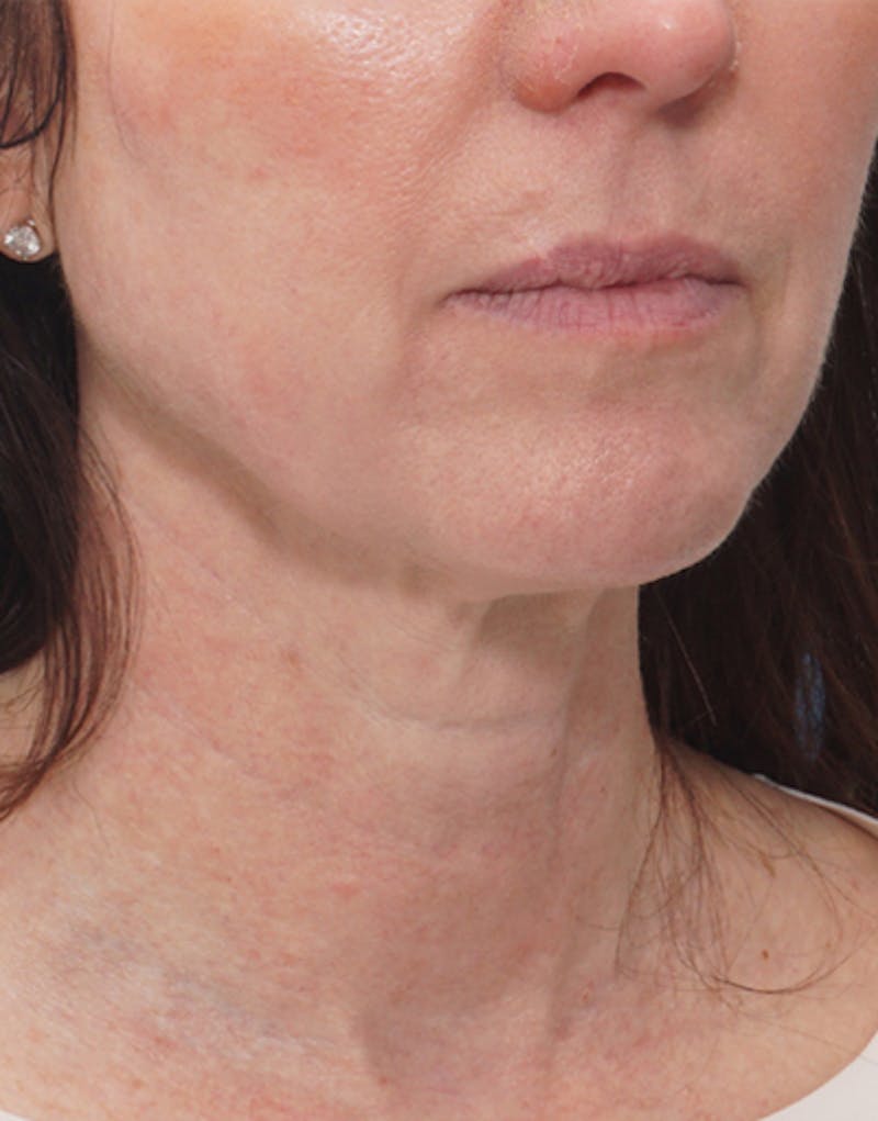 Jawline Contouring Before & After Gallery - Patient 170176 - Image 2