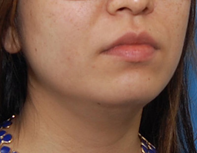 Kybella Before & After Gallery - Patient 379605 - Image 4
