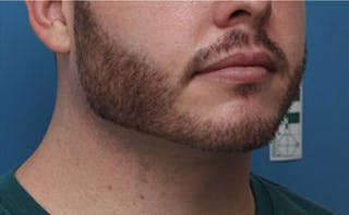 FaceTite Before & After Gallery - Patient 771200 - Image 6