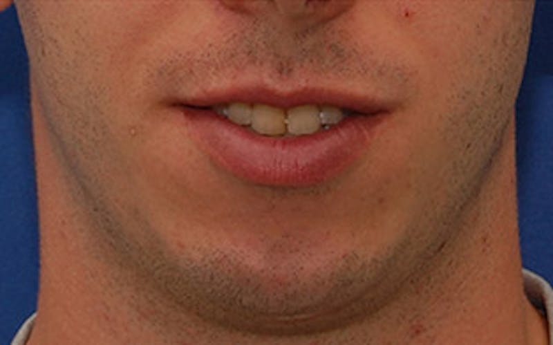 Chin Surgery Before & After Gallery - Patient 259350 - Image 7